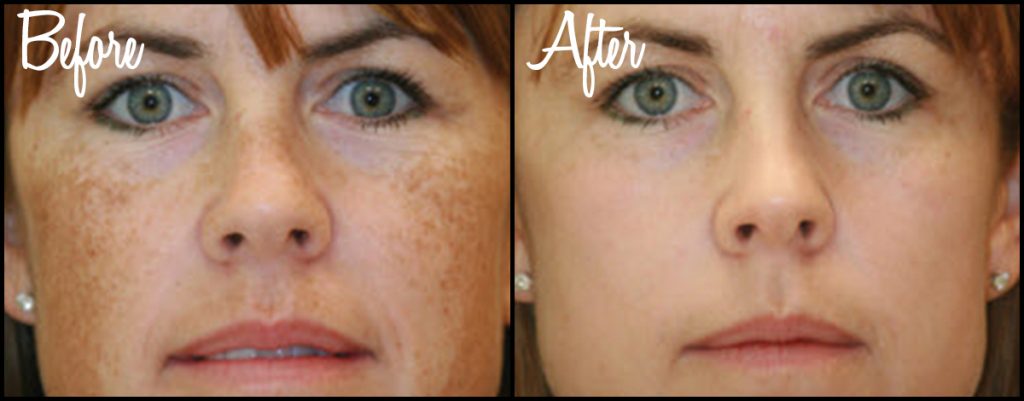 BBL Treatment: A Simple Way to Stay Young Forever